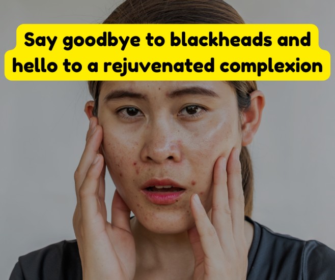 Effective 5 Home Remedies to Eliminate Blackheads